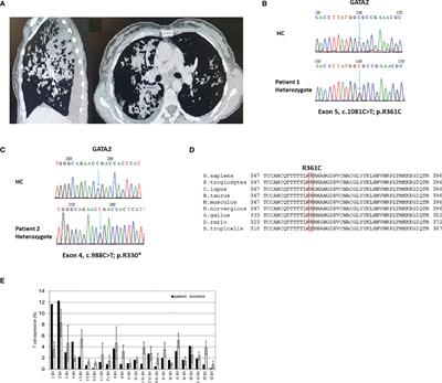 GATA2 Deficiency in Adult Life Is Characterized by Phenotypic Diversity and Delayed Diagnosis